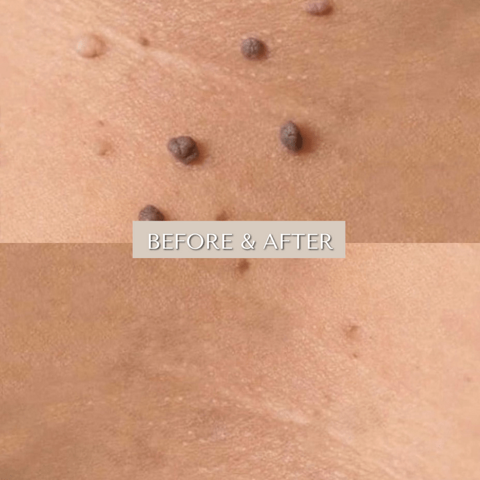 Single Skin Tag Removal 1–2" Skin Area